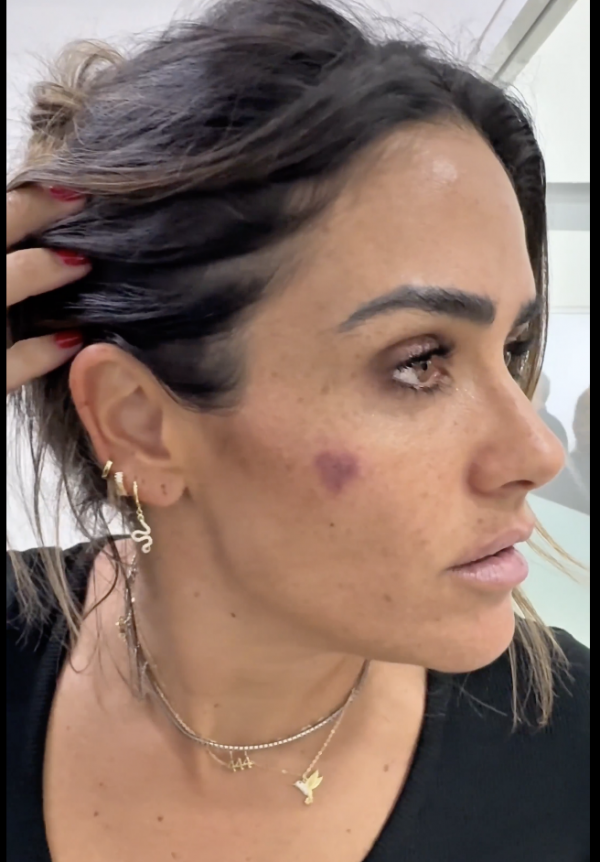 ‘Para que quede evidencia’: Así fue la agresión contra Alessandra Rojo y las lesiones que mostró